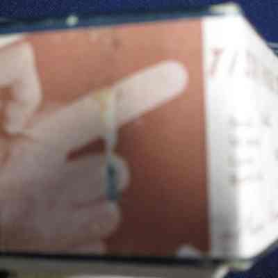 View of tissue finger cot.