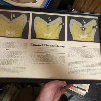 Enamel Fissure Decay Poster