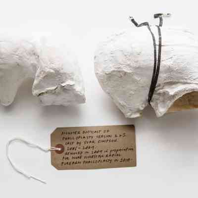 White plaster cast held together by tape.