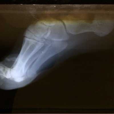 Glass X-Ray plate and envelope, foot of Herbert D. Clark, by order Dr. G. Bull, 1913