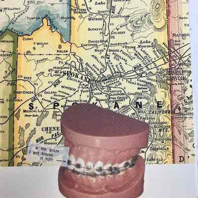 Spokane Braces 2