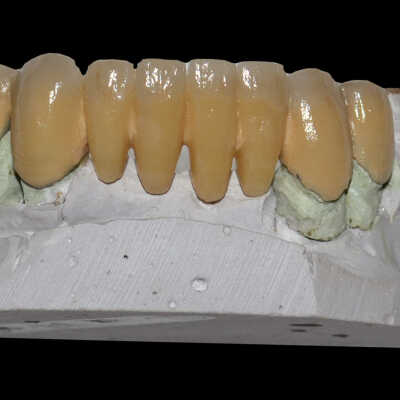 Tennessee Williams' Dental Bridge Mold