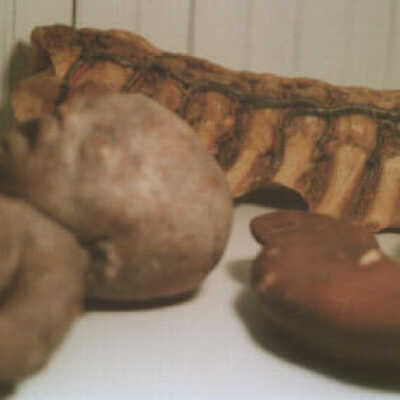 Plaster Model of Siamese Twin, Wax Verta