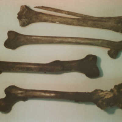 Bones Showing Pathologies & Anomalies